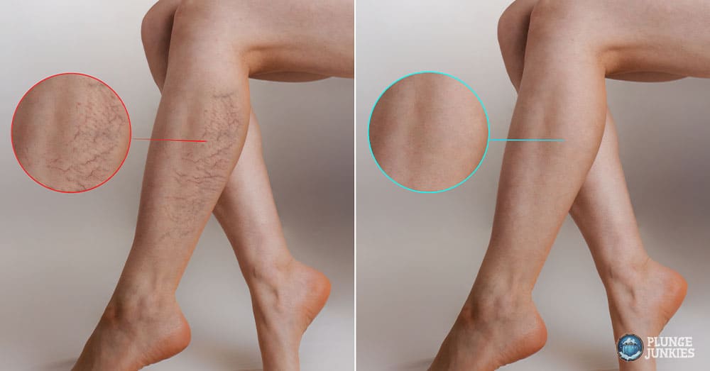 Cold Showers Minimizes Varicose Veins